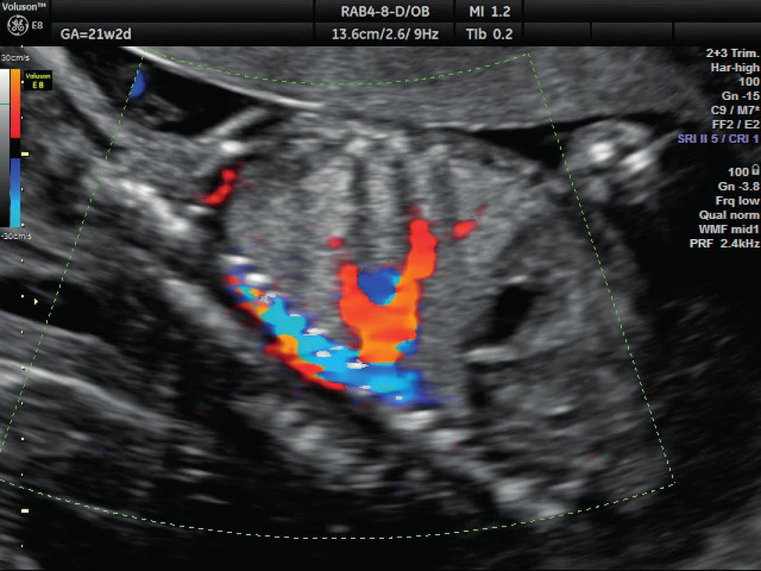 Ultrazvukové vyšetření ve 21. týdnu těhotenství – dopplerovské zobrazení přívodné cévy
Zobrazení aberantní systémové přívodné cévy vyživující sekvestr a odstupující z hrudní aorty