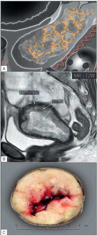 Velký endometriální karcinom infiltrativně rostoucí do myometria a stromatu děložního hrdla (FIGO stadium II)