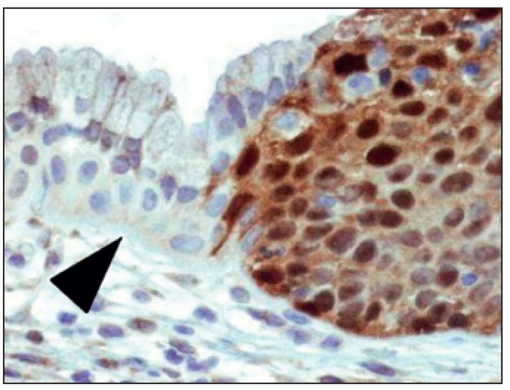 Imunohistologie p16 v HG lézi – těžce dysplastický epitel (vpravo) je pozitivní, zatímco cylindrický epitel endocervixu (vlevo) je negativní, včetně hyperplastických rezervních buněk (šipka)