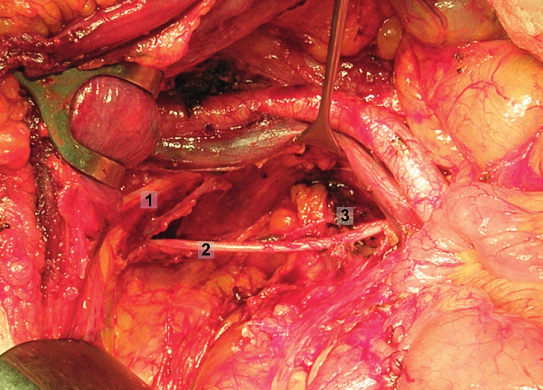 Systematická transperitoneální pánevní lymfadenektomie (pravá pánevní stěna) – pátý krok; obturatorní uzliny byly kompletně exstirpovány, odděleny od kosti stydké, obturatorního nervu a vnitřních ilických cév. 1 – stydká kost, 2 – obturatorní nerv, 3 – obturatorní arterie