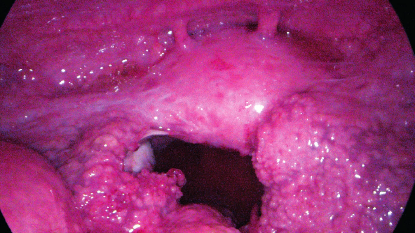 Laparoskopický nález: miliární rozsev na peritoneu, ascites, výrazná dilatace a deformace vejcovodů