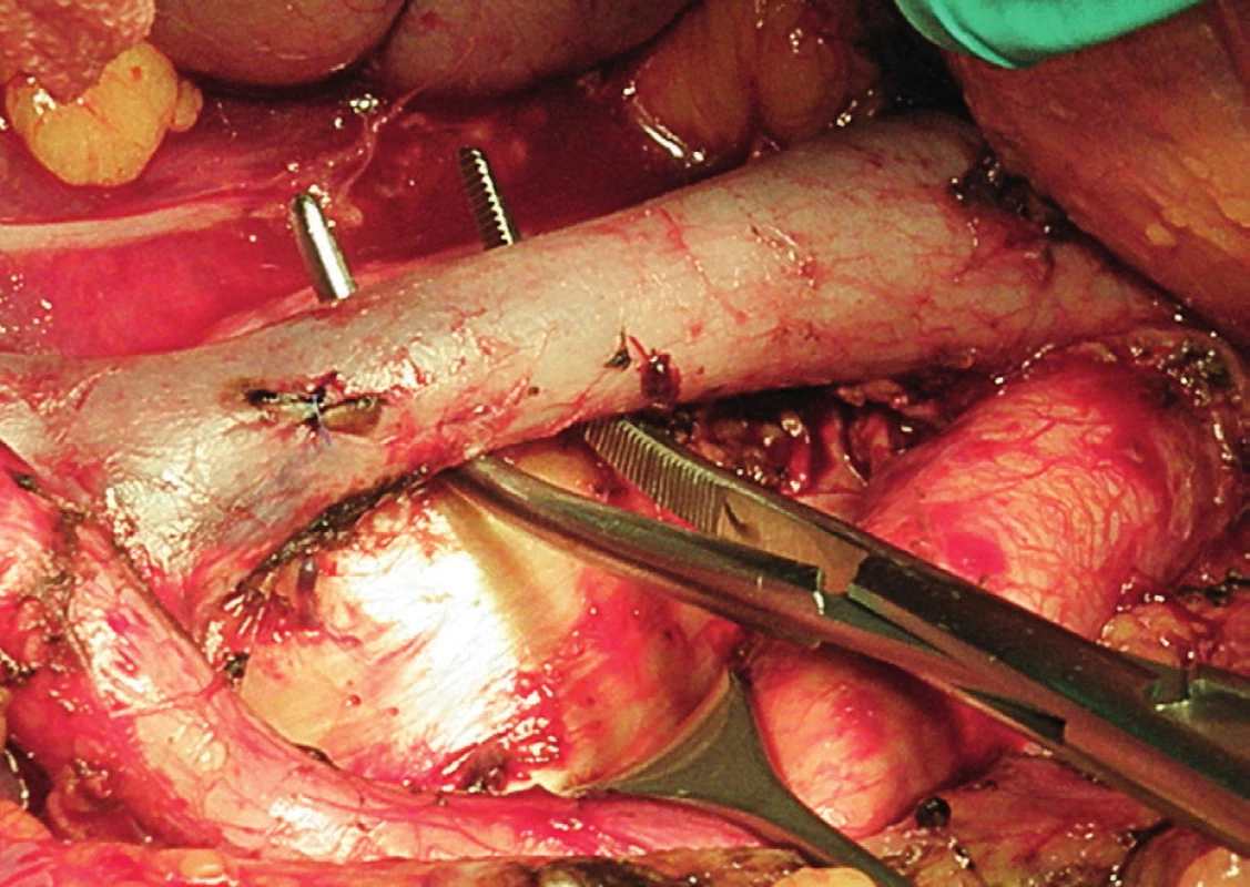 Systematická transperitoneální paraaortální lymfadenektomie – pátý krok; lumbální vény byly koagulovány, aorta a dolní dutá žíla od sebe odtaženy laterálně a hluboké interaortokavální uzliny a zbytek retrokaválních uzlin exstirpovány