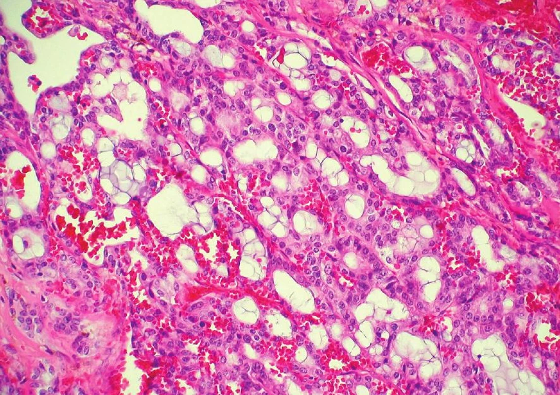 Metastáza karcinomu příušní žlázy z acinárních buněk mimikující sekretorický karcinom prsu