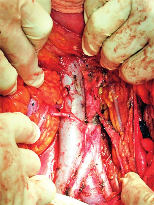 Anatomie suprapelvické oblasti při ptóze pravé ledviny