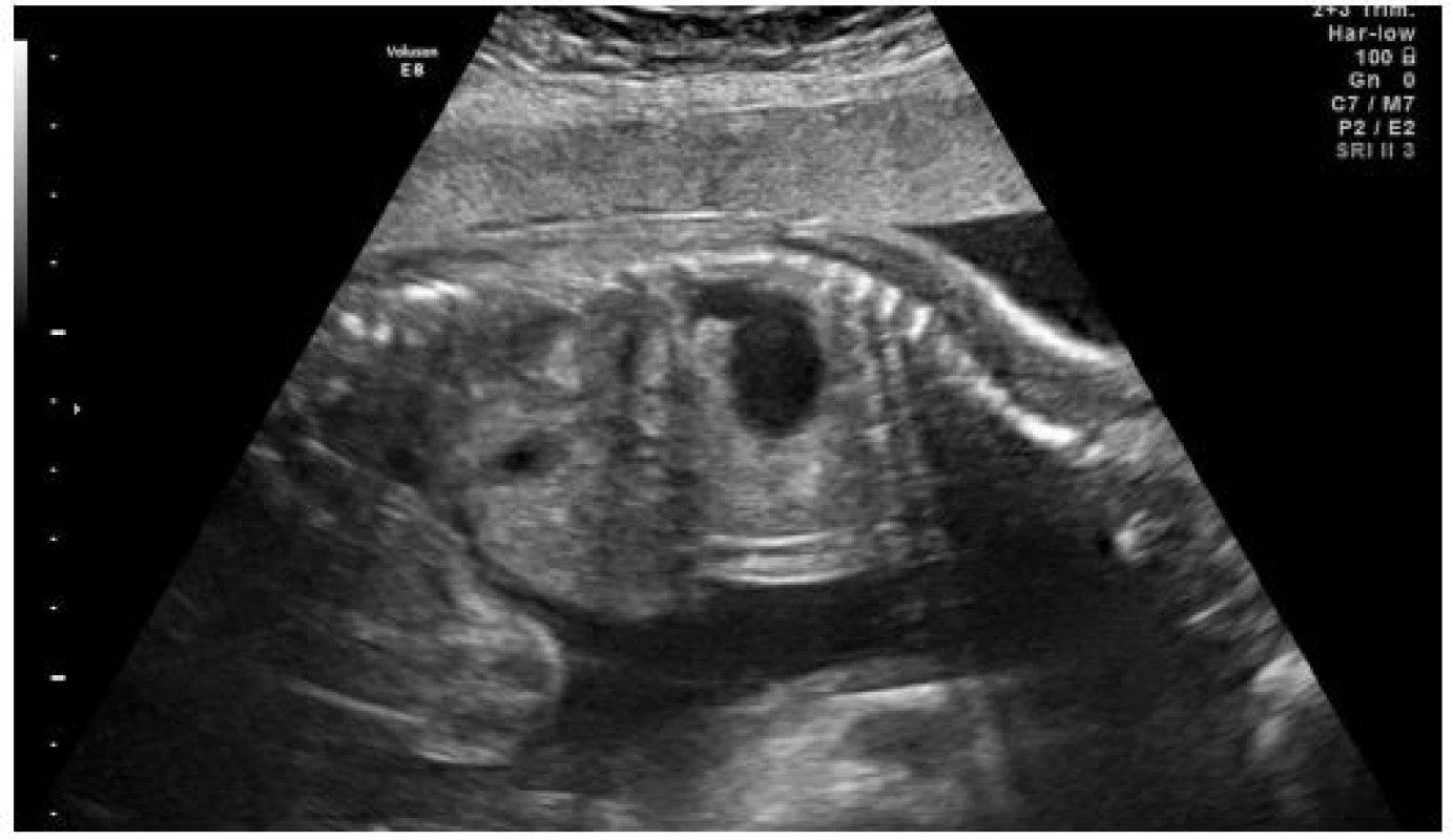 Sagitální řez levou polovinou těla plodu. Žaludek se zobrazuje v hrudní dutině (z vlastního archivu)