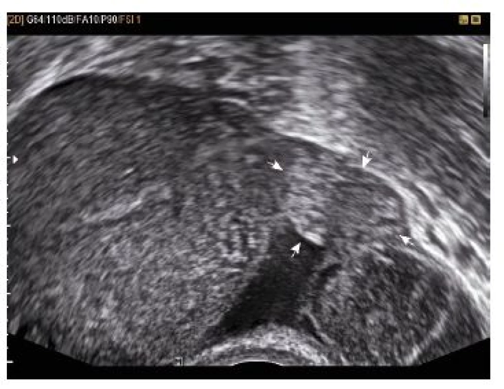 Mezi dělohou a ovariem vlevo je oválná solidní lehce nehomogenní rezistence velikosti 20 mm bez typických struktur plodového vejce – suspektní graviditas extrauterina tubaria 
l. sin.
