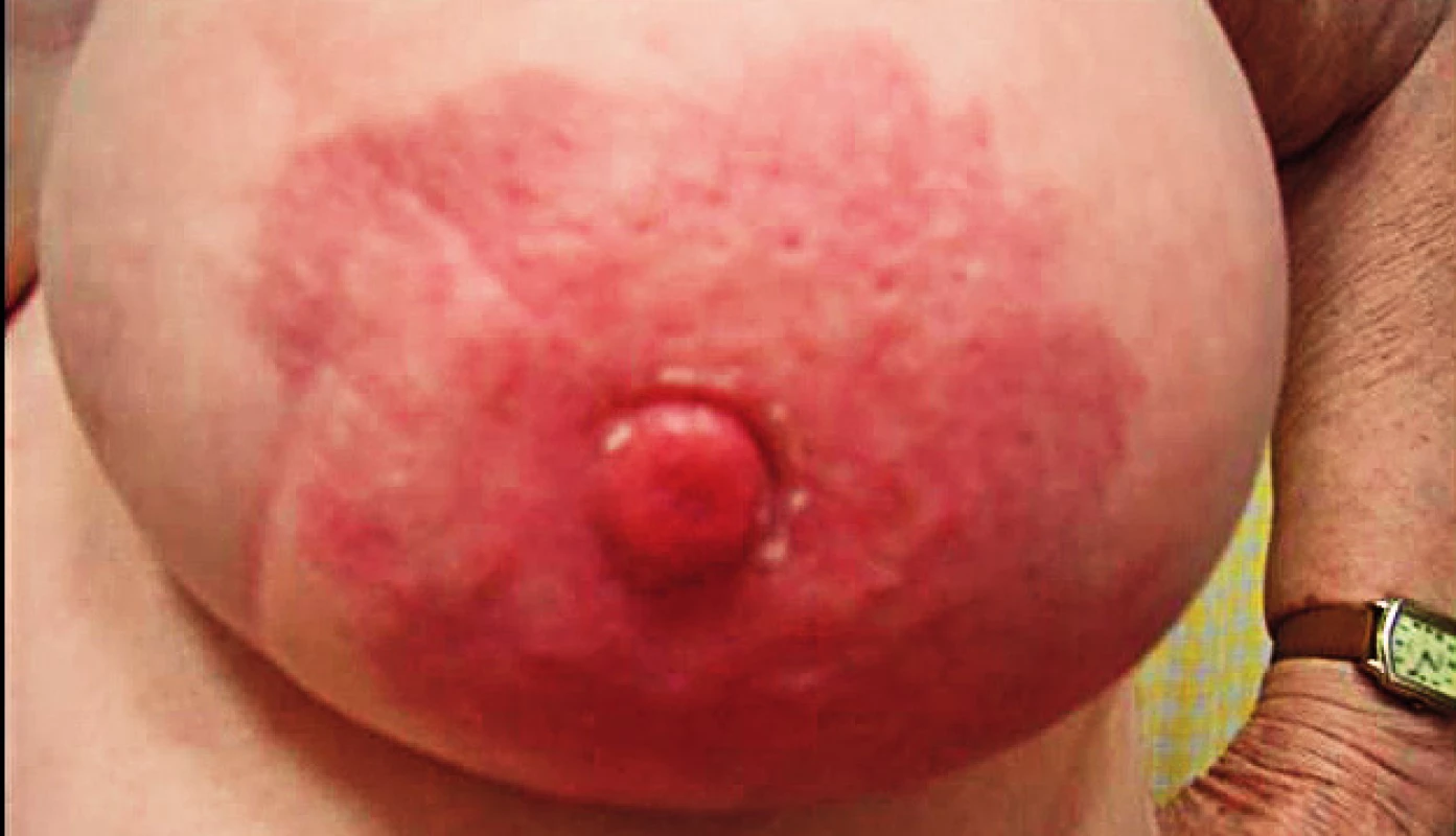 Zarudnutí části či celého prsu, oteplení kůže (koincidence inflamatorního a intramamárního karcinomu)