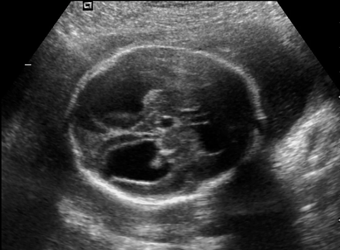 Ultrazvukové vyšetření ve 24. týdnu, ventrikulomegalie, zadní rohy postranních komor široce komunikují se subarachnoidálním prostorem