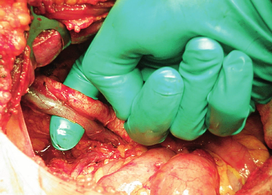 Systematická transperitoneální pánevní lymfadenektomie (pravá pánevní stěna) – třetí krok; zevní ilická arterie a véna byly odděleny od sebe navzájem a od m. psoas, ukazovák vložen mezi cévy a sval. Cévy byly jemně odsunuty mediálně, a tím zpřístupněn laterodorzální prostor k exstirpaci uzlin.