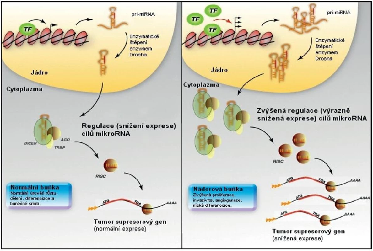 Transkripční kontrola exprese mikroRNA. V normální buňce probíhá normální regulace transkripce mikroRNA genů pomocí transkripčních faktorů (vlevo). Zvýšená exprese a/nebo aktivace transkripčního faktoru v nevhodnou dobu nebo prostoru (vpravo) může vést ke zvýšení exprese mikroRNA regulujících tumor supresorový gen, a tím ke snížení jeho exprese u nádorových buněk. Upraveno podle [7].