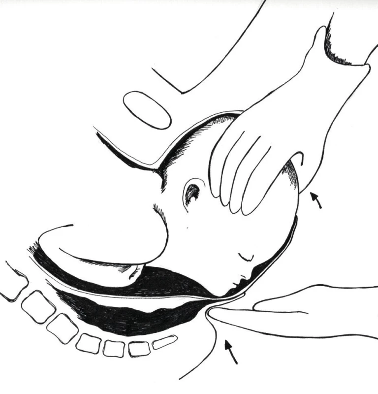 Ritgenův manévr: V čase mimo kontrakci dominantní ruka špičkami čtyř prstů vyvíjí tlak dovnitř a dopředu přes zadní hráz na bradičku plodu. Druhá ruka současně reguluje rychlost prostupu hlavičky a navádí ji tak, aby prošla skrze perineální struktury svým nejmenším obvodem.