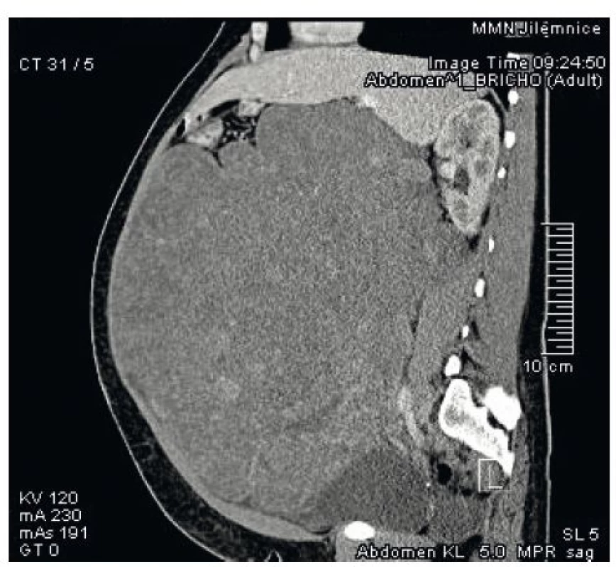 CT břicha – sagitální řez