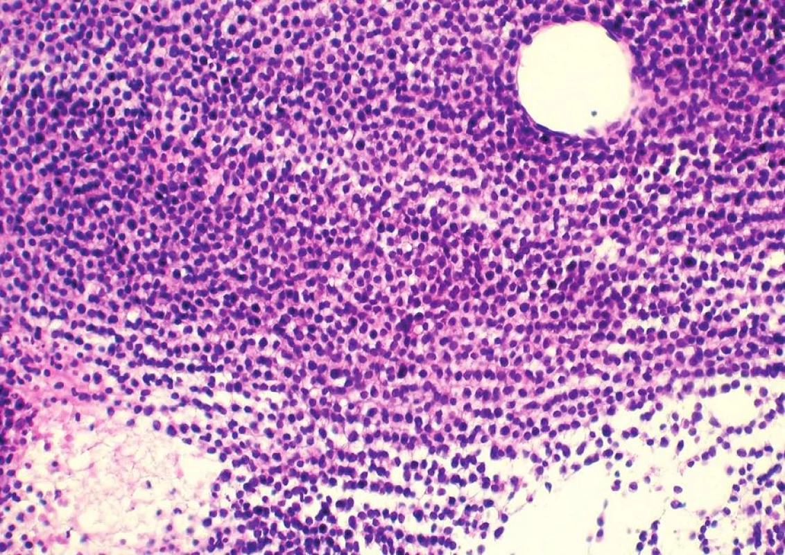 Metastáza melanomu s řádkováním nádorových buněk připomínajícím maligní lymfom či invazivní lobulární karcinom