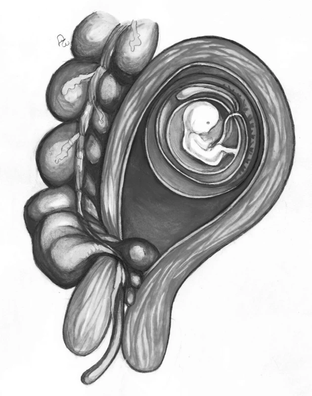 Ilustračný obrázok protrúzie apendixu cez perforovaný cervix uteru