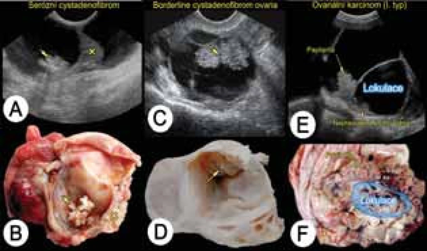 Benigní, borderline a invazivní ovariální nádor (karcinom)
