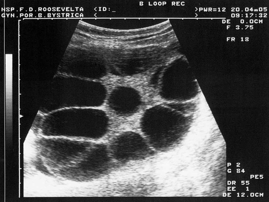Ultrasonografický nález pravého ovária v 10. GW v prvej gravidite