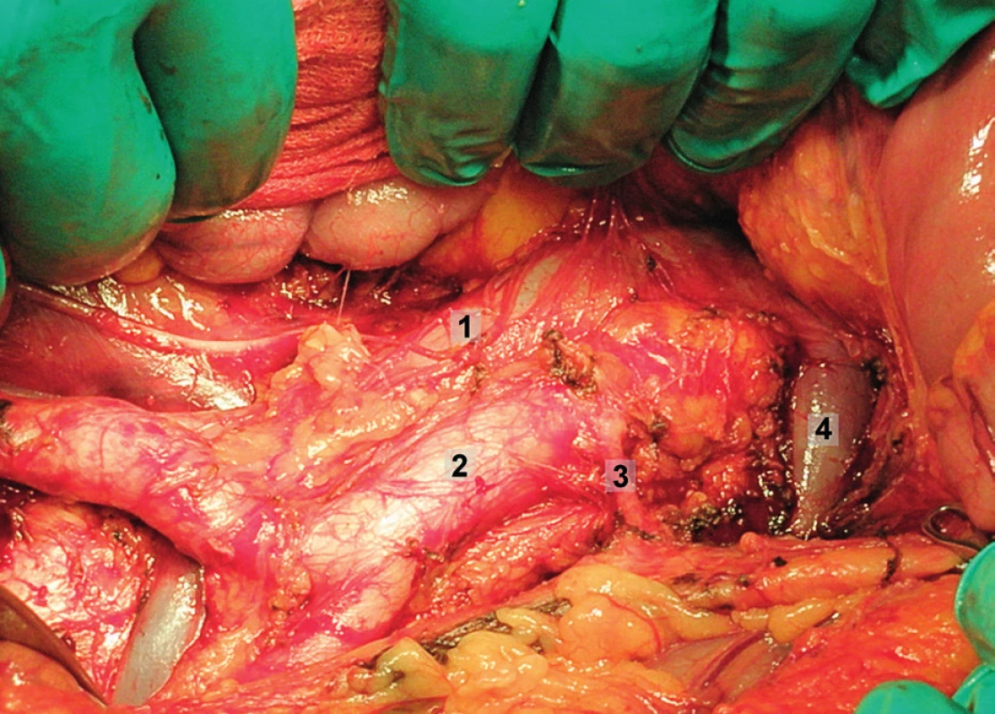 Systematická transperitoneální paraaortální lymfadenektomie – druhý krok; pomocí tupé a ostré preparace jsou ozřejmeny laterální a kraniální hranice paraaortální lymfadenektomie, hlavní anatomické struktury. 1 – dolní dutá žíla, 2 – aorta, 3 – a. mesenterica inferior, 4 – levá renální véna
