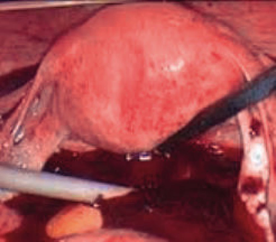 Haemoperitoneum