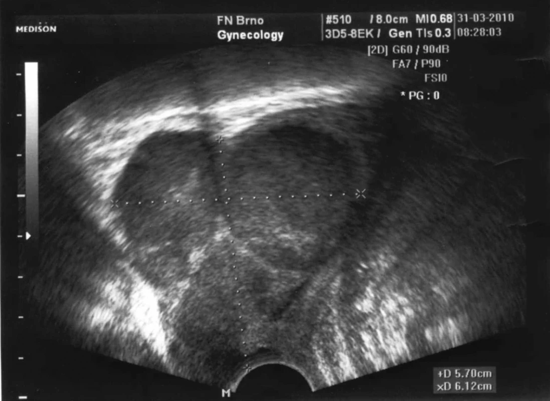 Ultrazvukový obraz regredovaného lymfomu spotřebovávajícího hrdlo děložní