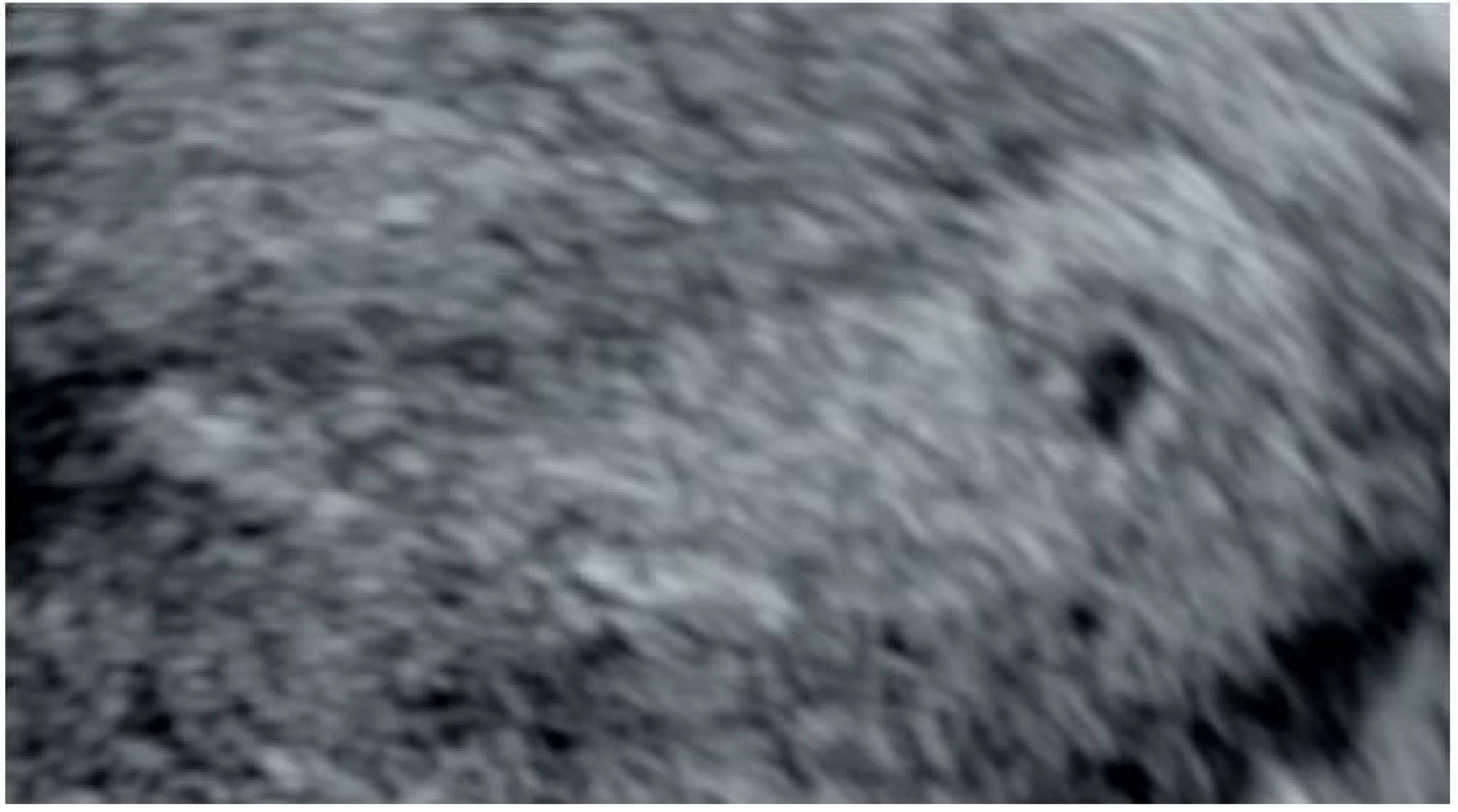 Intrauterinní těhotenství v 5. gestačním týdnu
Ultrazvukové zobrazení gestačního váčku jako dutinky s hyperechogenním lemem lokalizované excentricky v homogenním, vysokém, deciduálně změněném endometriu, průměr gestačního váčku 4,5 mm (odpovídá grav. hebd. 4+5).