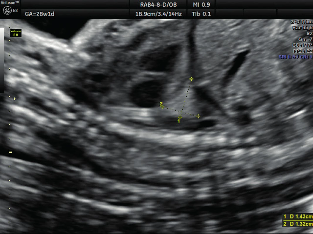 Ultrazvukové vyšetření v 28. týdnu těhotenství – brochopulmonální sekvestrace
Regrese nálezu, hyperechogenní útvar o velikosti přibližně 1 cm (plicní sekvestr)