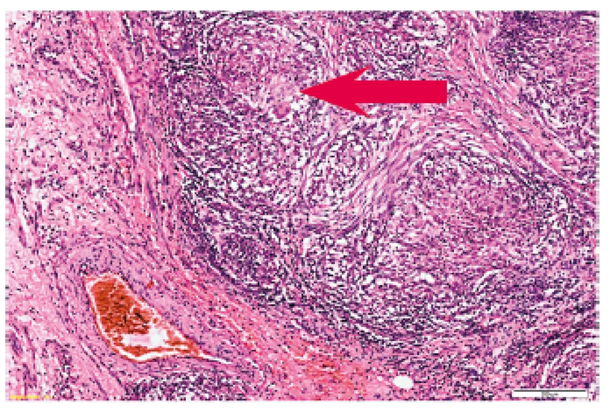 Histopatologie: splývající epiteloidní granulomy a lymfocytární infiltrát.