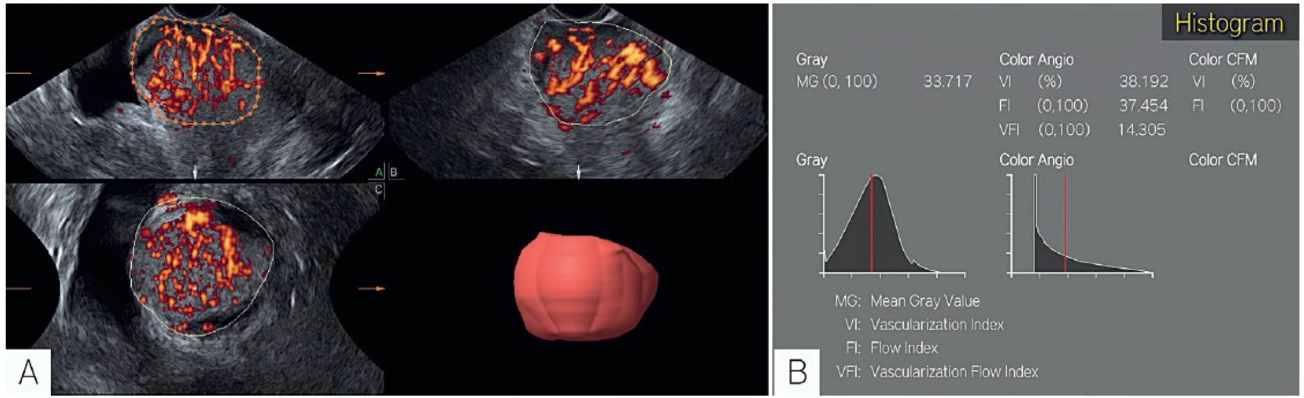 Trojrozměrný ultrazvuk (objektivní zobrazení cévní perfuze)