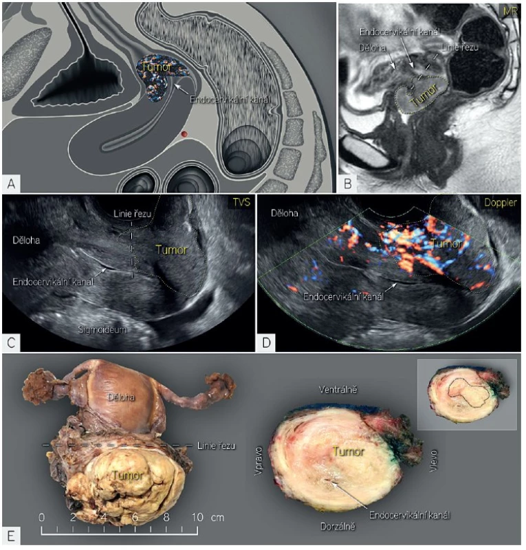 Zobrazení velkého dlaždicobuněčného karcinomu ultrazvukem a magnetickou rezonancí