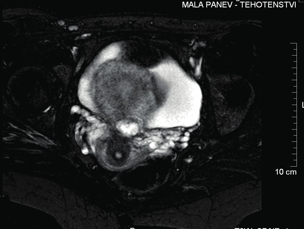 MRI malé pánve – transverzální řez