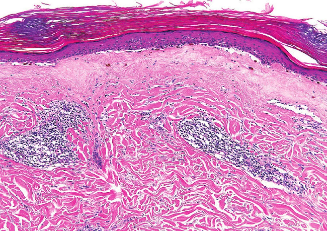 Plně rozvinuté stadium lichen sclerosus (s homogenním ztluštěním kolagenových vláken subepiteliálně)