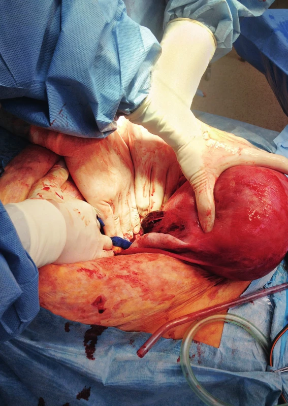 Ruptura dělohy, vizualizována během operace