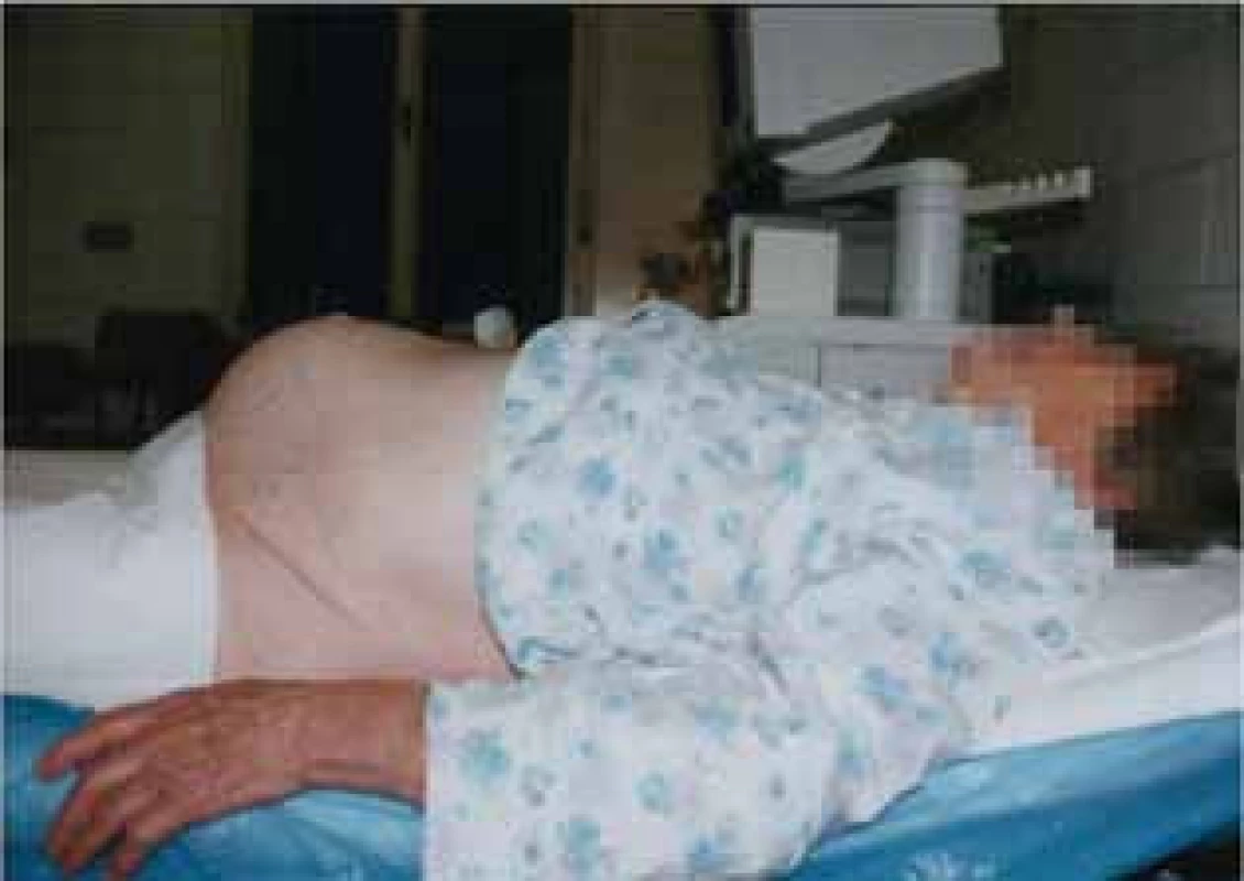 Pacientka s pokročilým ovariálním karcinomem a ascitem