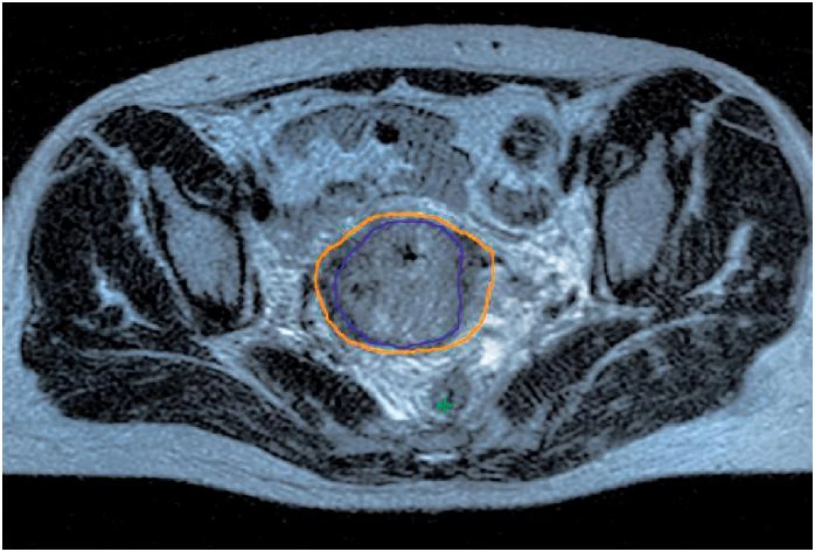 Konturace cílového objemu (GTV modře, HR CTV oranžově); GTV – makroskopický tumor, HR CTV – oblast klinického cílového objemu s vysokým rizikem