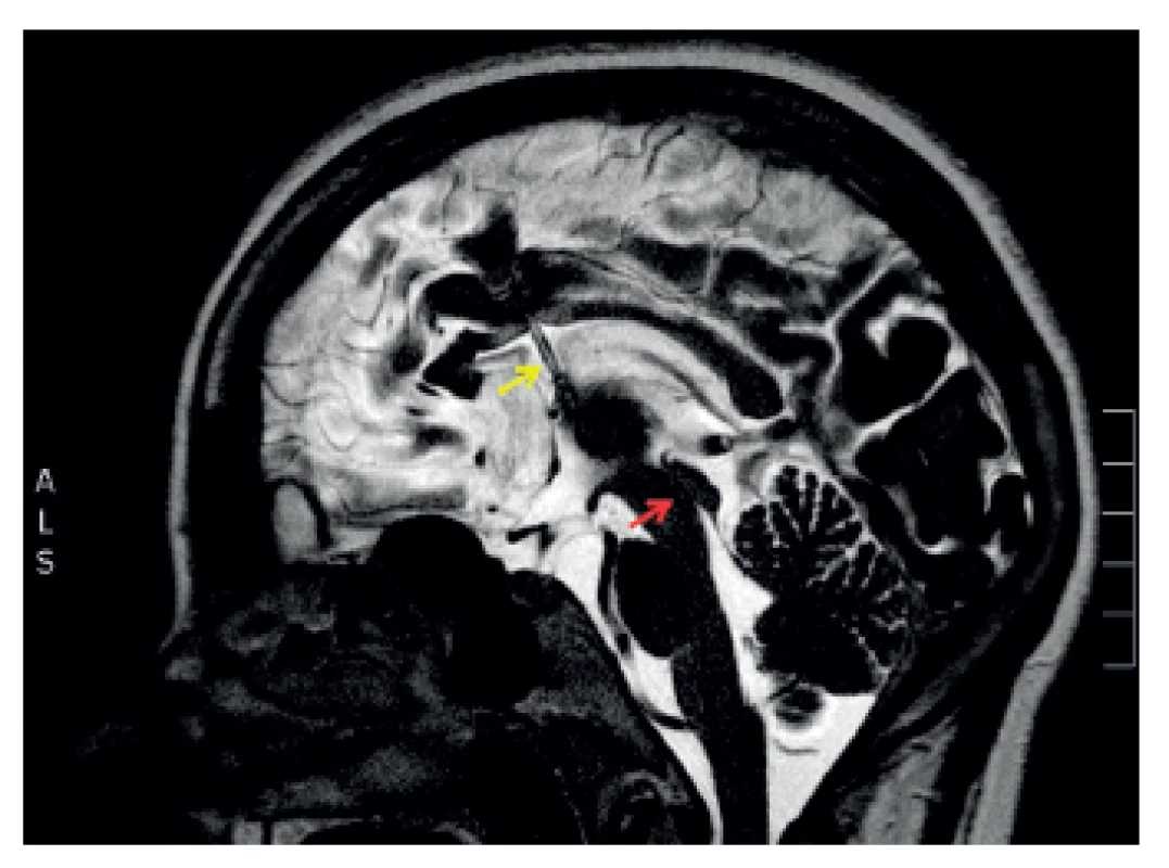 Na magnetické rezonanci v T2 vážené sekvenci v sagitálním řezu je zobrazena pacientka s obstrukčním hydrocefalem (místo obstrukce – Sylviův mokovod – označeno červenou šipkou) s implantovaným shuntem (katétr v komorovém systému označen žlutou šipkou)