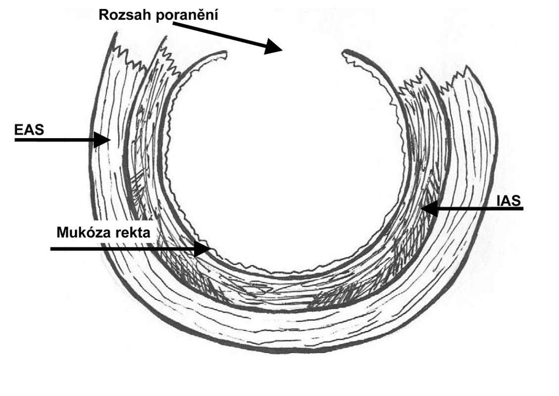 Ruptura perinea 4. stupně podle RCOG
