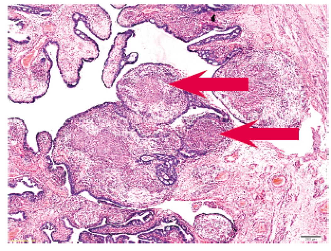 Histopatologie: detail polypoidně utvářené sliznice s epiteloidními granulomy (šipky).