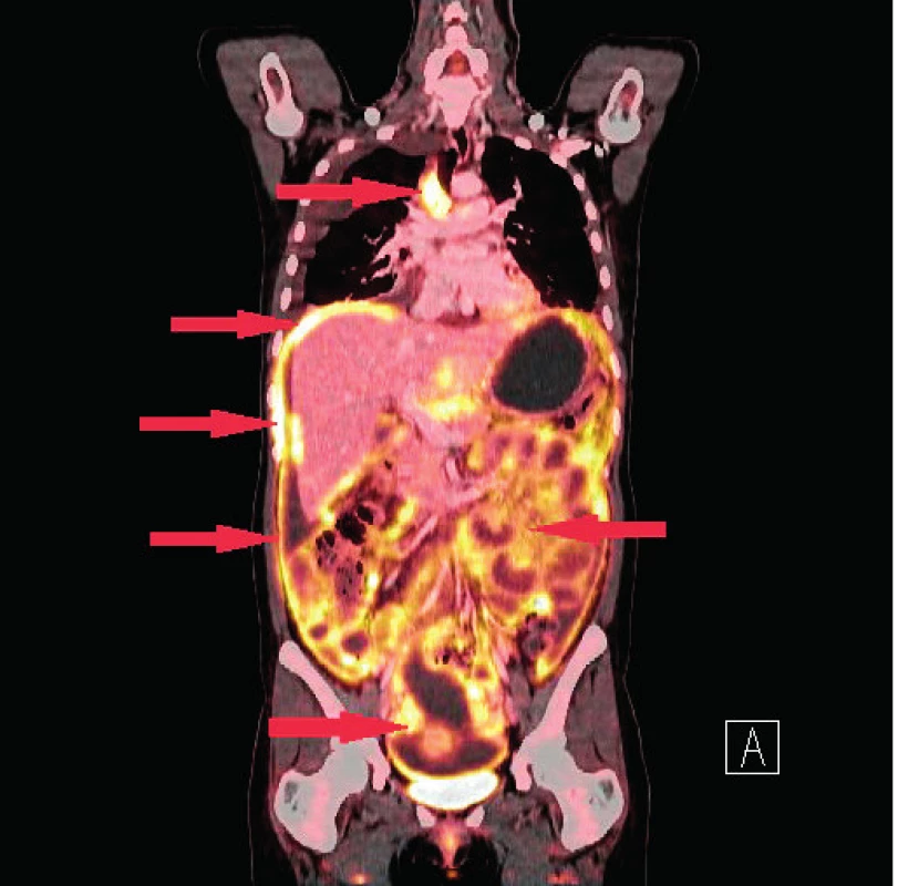PET/CT snímek, šipky poukazují na místa s největší akumulací 18F-FDG – viscerální a parietální peritoneum, ovaria, lymfatické uzliny v mediastinu, ložiska na pleuře