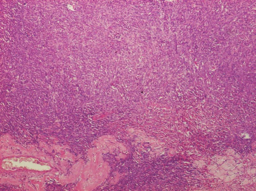 Histologický obraz ovariálního stromatu infiltrovaného duktálním karcinomem (HE, 4x)
