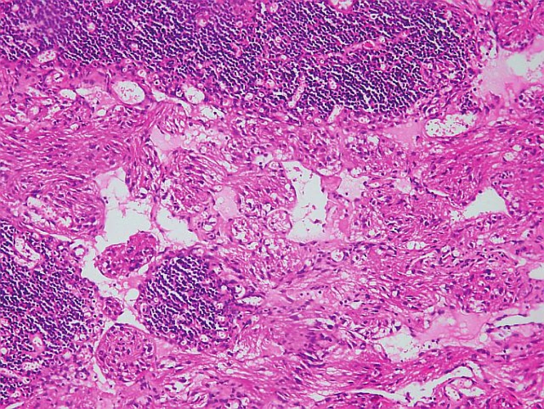 Mikroskopické vyšetrenie lymfatickej uzliny s charakteristickou abnormálnou proliferáciou nezrelých buniek hladkého svalu (hematoxilín-eozín, zväčšené 200×).