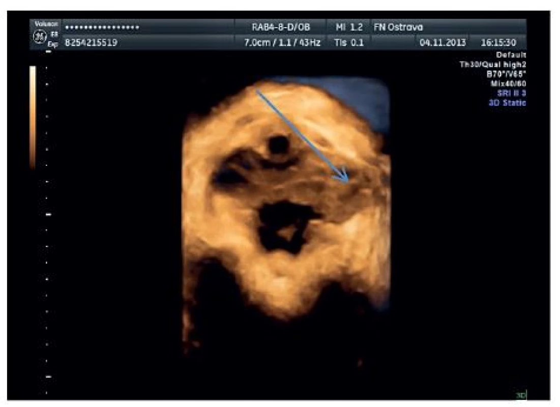 Avulzní poranění m. levator ani vlevo u 31leté primipary sedm měsíců po porodu pomocí vakuumextrakce (označeno šipkou)