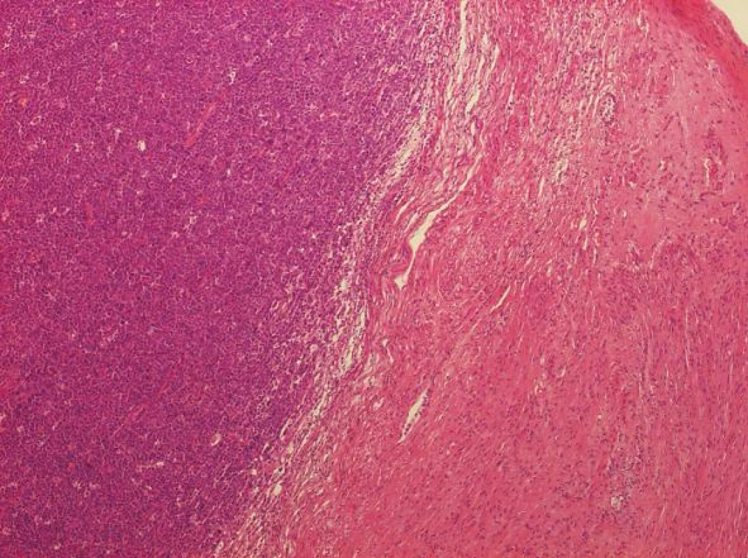 Histologický obraz lymfomové infiltrace cervikálního stromatu (HE, 4x)