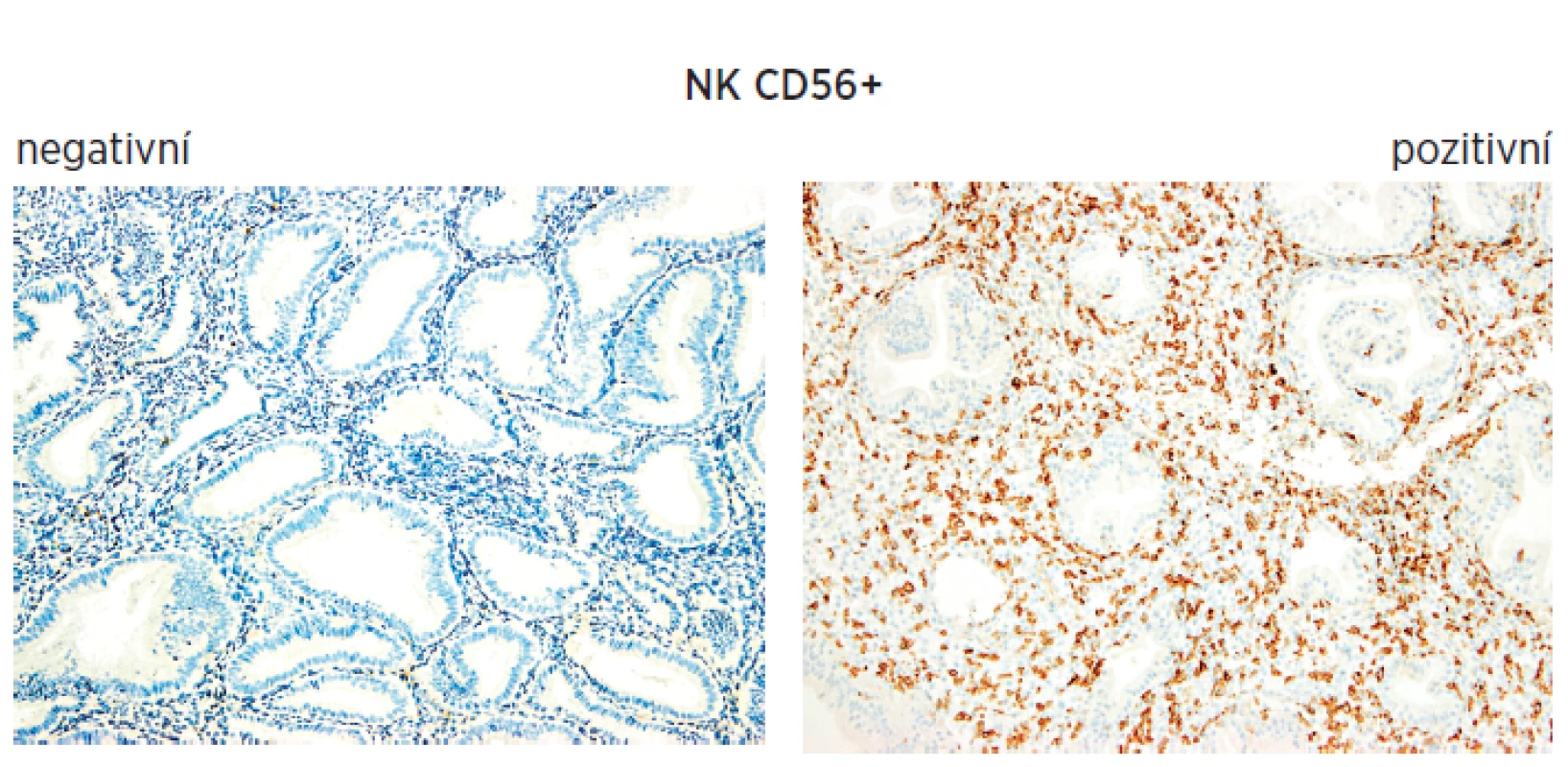 Immunohistochemie endometria při sledování NK bb CD56+