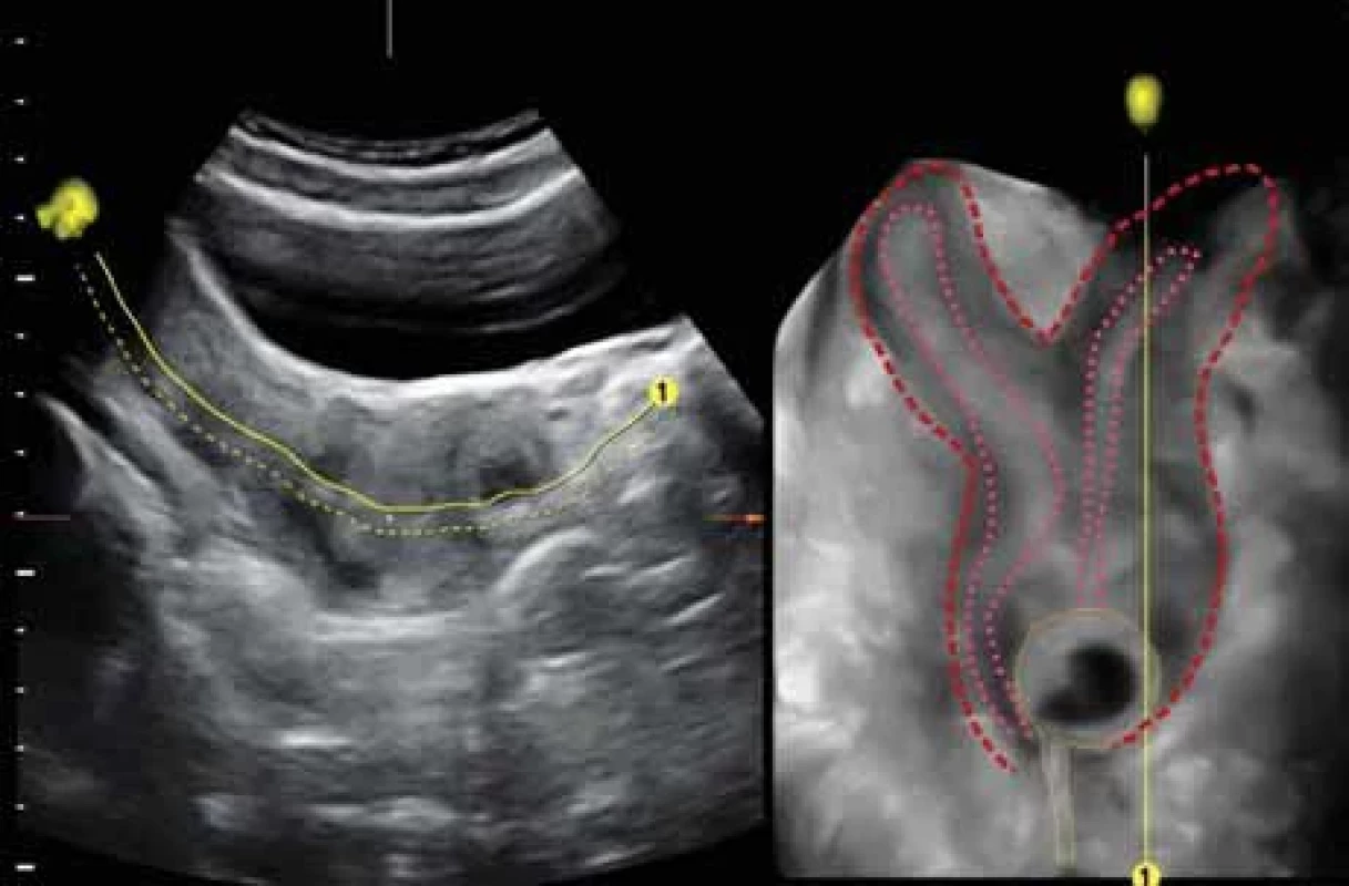 Post-surgery imaging. Transabdominal virtual contrast imaging OmniView image showing uterus with two horns (red dashed line), two normal non-dilated cavities (pink dashed lines), and a Foley balloon (yellow dotted line) inserted in an empty hemivagina.