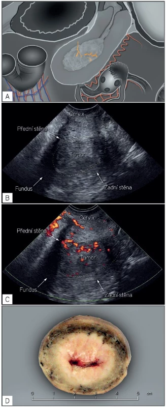 Endometriální karcinom s vysokým rizikem postižení lymfatických uzlin (FIGO stadium II)