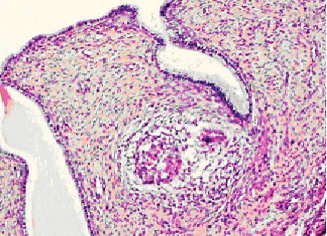 Sarkoidní granulom v mezosalpinx (archivní smímek MUDr. Žurkové)