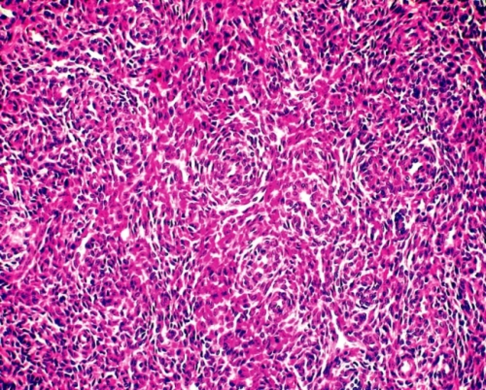 ESS. Denzní, monotónní, naznačeně plsťovité uspořádání nádoru tvořeného buňkami s pravidelnými oválnými, bazofilními jádry s malým množstvím cytoplazmy. Tumor je protkán sítí drobných arteriol (HE, 200x)