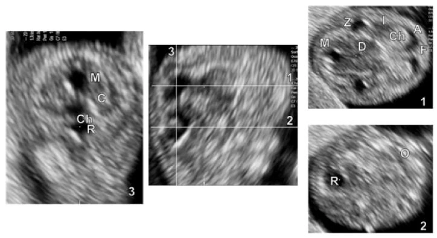 UZ zobrazení embrya ve 12. týdnu. Mediosagitální rovina (uprostřed), transverzální řezy (1 a 2), frontální řez (3). CRL = 44,3 mm.
A – přední rohy, Z – zadní rohy postranních komor, D – diencefalon (s III. komorou), M – mezencefalon (budoucí aqueductus), R – rombencefalon (se IV. komorou), Ch – choroidní plexy, F – falx cerebri, I – inzula, O – orbita