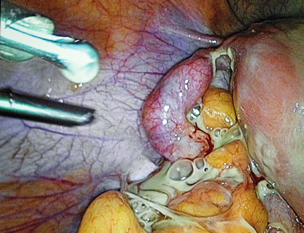 TOA – laparoskopická fáze operace.