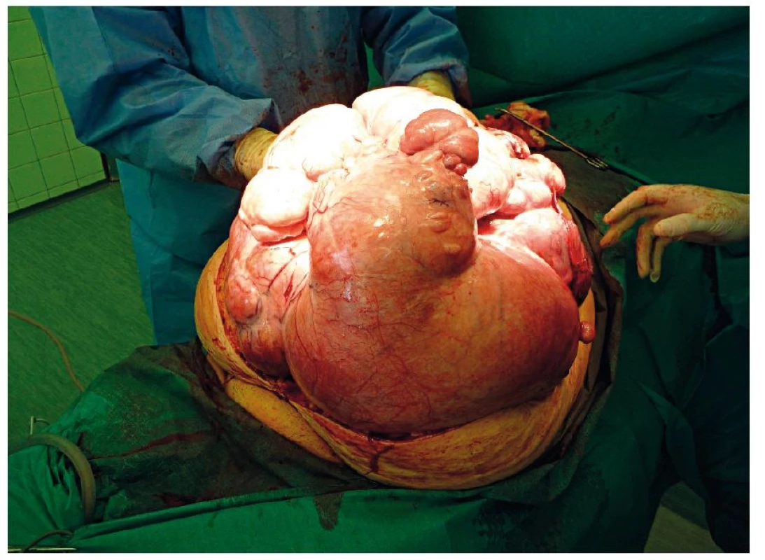 Gigantický tumor po otevření dutiny břišní