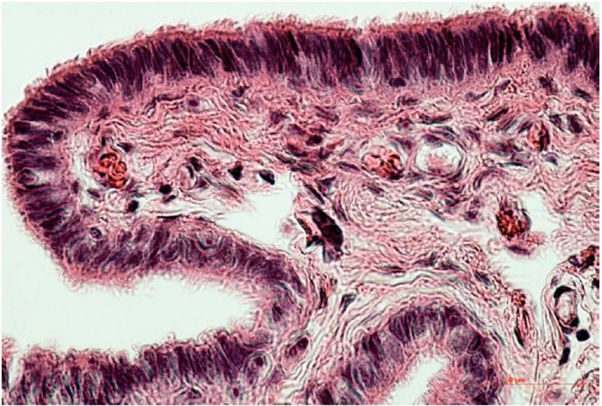 Jednovrstvový cylindrický epitel s prevahou buniek s riasinkami na povrchu fimbrií 45-ročnej ženy
(hematoxylín a eozín, zv. 400x)